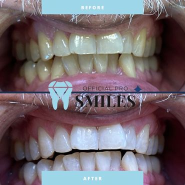 Professional teeth whitening results at Official Pro Smiles in Mesa, Arizona