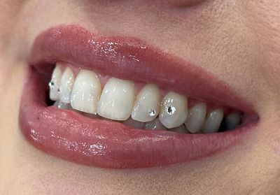 tooth gems on 4 teeth, book your tooth gems in Mesa Arizona
