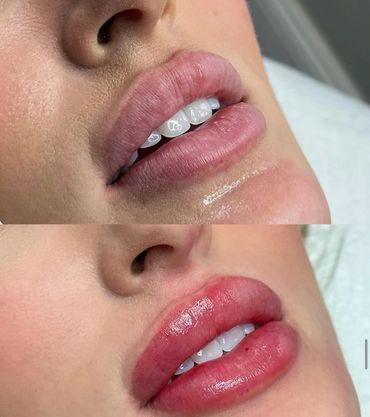 Before and after lip enhancement showing fuller, glossier lips.