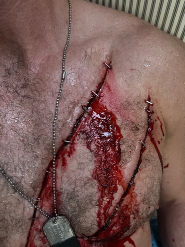 Close-up of a chest with deep, bleeding wounds held together by metal staples.