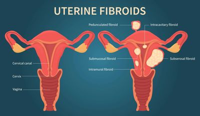 Fibroid image from USA Fibroid Centers. Tenderyoni does not own this image.