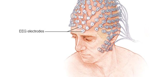An electroencephalogram (EEG) is a test used to find problems related to electrical activity of the 