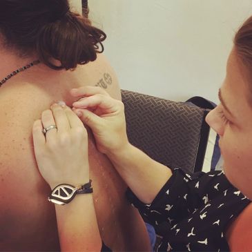 acupuncture for pain relief