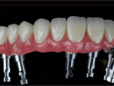 Dentures with metal implants on a black background.