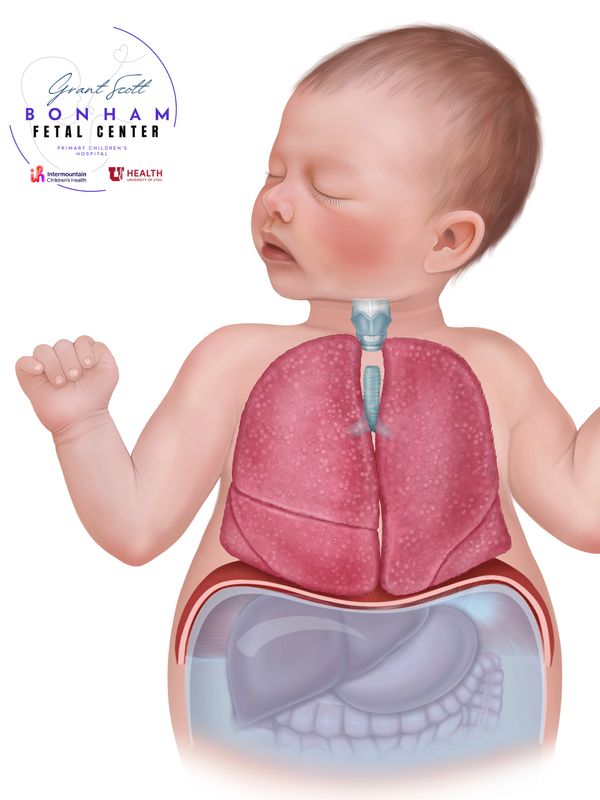 Child with CHAOS treated through the Grant Scott Bonham Fetal Center at Primary Childrens Hospital