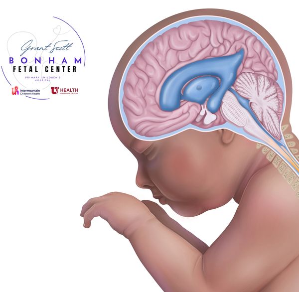Child with hydrocephalus seen by a multidisciplinary care team at Grant Scott Bonham Fetal Center