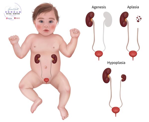 Child with renal dysplasia treated at the Grant Scott Bonham Fetal Center in Salt Lake City, Utah