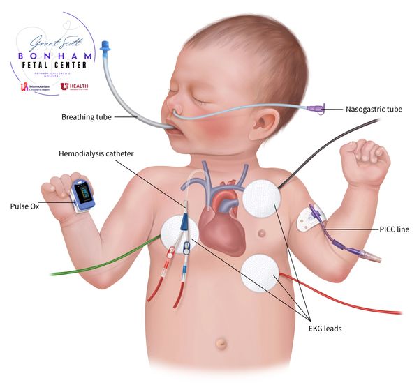 Multidisciplinary care of a child with renal agenesis treated at Primary Children's Hospital in Utah