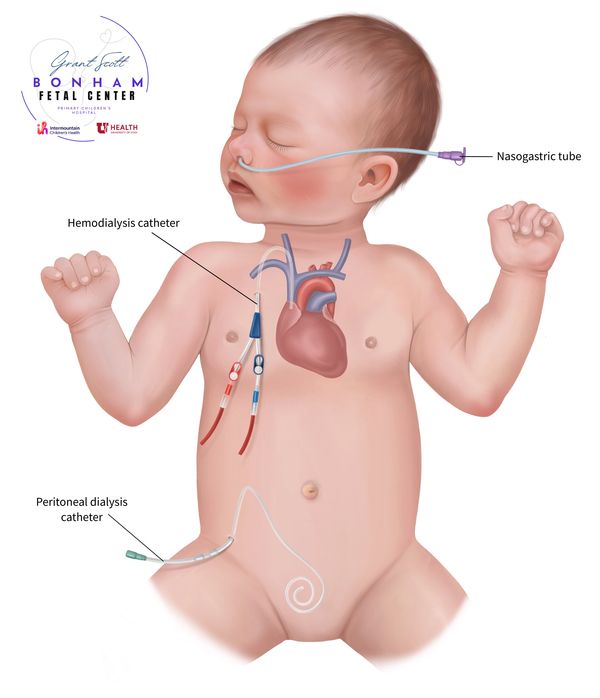 Multidisciplinary care of a child with renal agenesis treated at Primary Children's Hospital in Utah