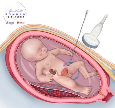Multidisciplinary care of a child with renal agenesis treated at Primary Children's Hospital in Utah