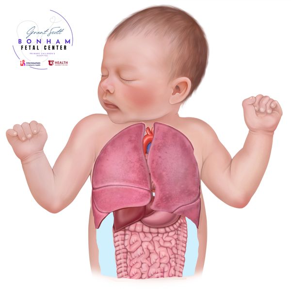 Baby with CHAOS treated at the Grant Scott Bonham Fetal Center at Primary Childrens Hospital in Utah