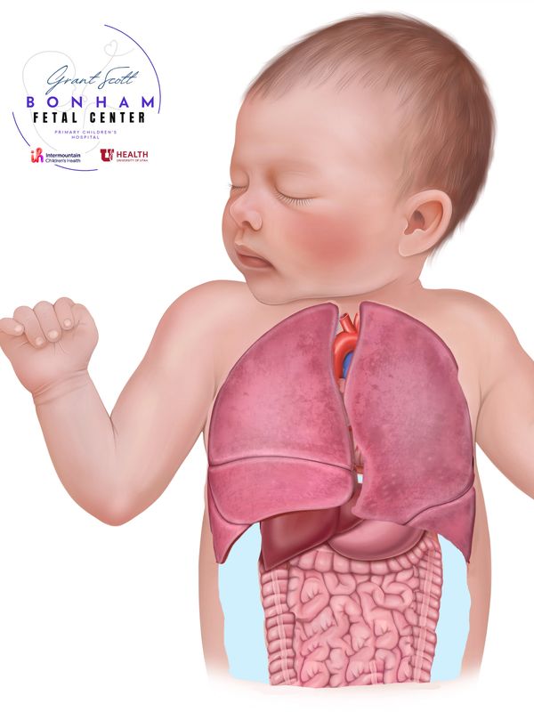 Baby with CHAOS treated at the Grant Scott Bonham Fetal Center at Primary Childrens Hospital in Utah