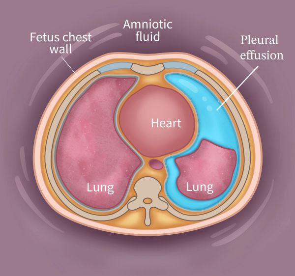 Fetus with pleural effusion receiving multidisciplinary care, including fetal surgery in Utah