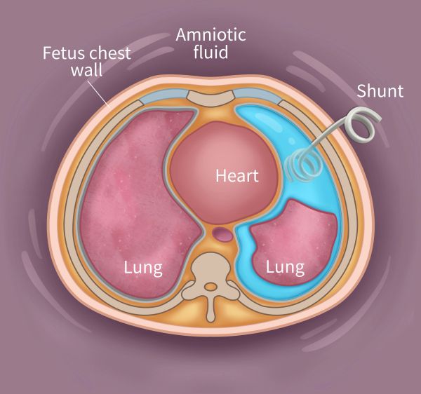 Fetus with pleural effusion receiving multidisciplinary care, including fetal surgery in Utah