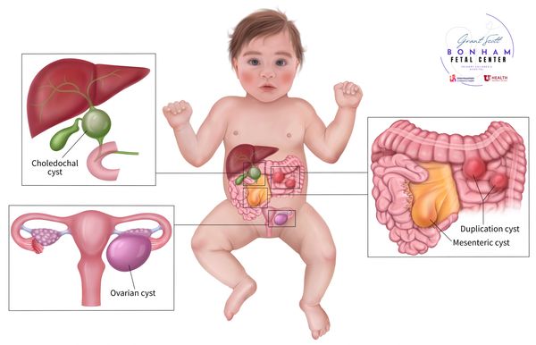 Intraabdominal cysts treated at the Grant Scott Bonham Fetal Center at Primary Childrens Hospital