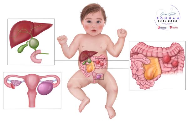 Intraabdominal cysts treated at the Grant Scott Bonham Fetal Center at Primary Childrens Hospital