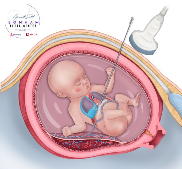Fetus with pleural effusion receiving multidisciplinary care, including fetal surgery in Utah