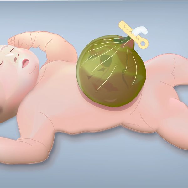 Giant omphalocele treated at the Grant Scott Bonham Fetal Center at Primary Childrens Hospital