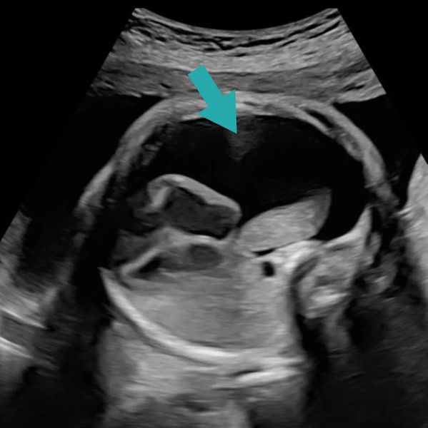 Ultrasound of fetus with pleural effusion receiving multidisciplinary care, including fetal surgery 