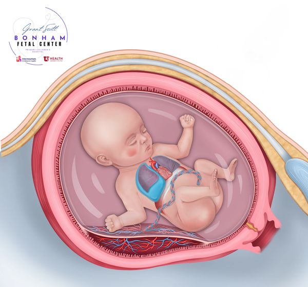 Fetus with pleural effusion receiving multidisciplinary care, including fetal surgery in Utah