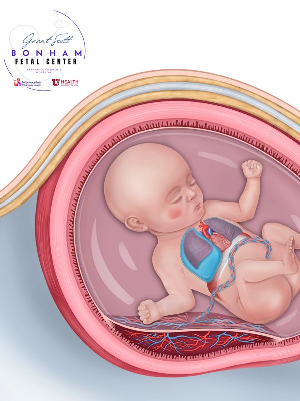 Fetus with cervical teratoma, treated at the Grant Scott Bonham Fetal Center in Salt Lake City, Utah