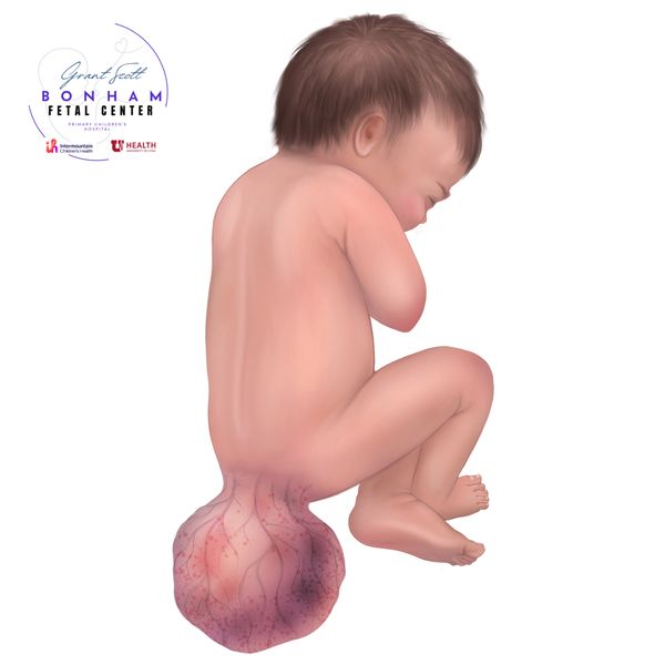 Child with SCT treated through the Grant Scott Bonham Fetal Center at Primary Children’s Hospital