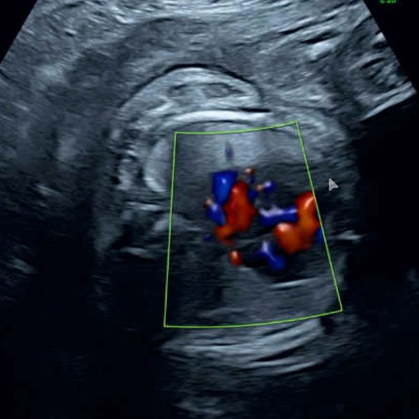 Echocardiogram of a fetus with an SCT treated at the Grant Scott Bonham Fetal Center in Utah
