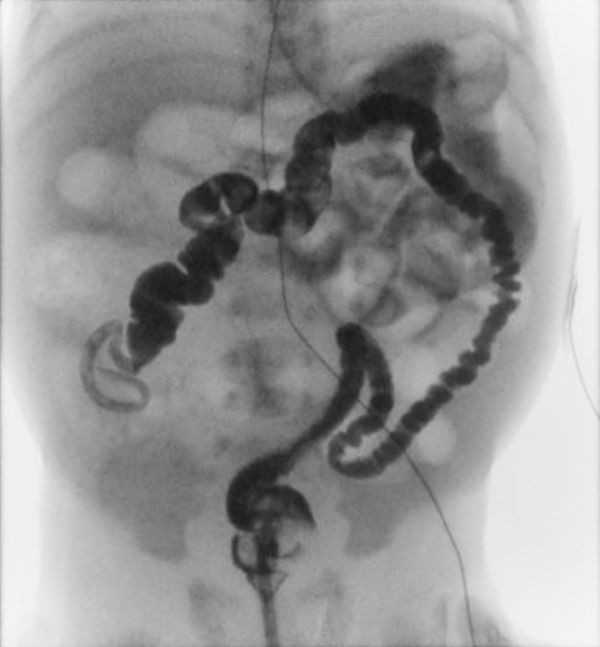 X-ray showing a barium enema highlighting the colon's shape and structure.