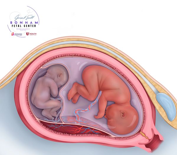 Twins requiring fetal surgery for TTTS at the Grant Scott Bonham Fetal Center in Salt Lake City,Utah
