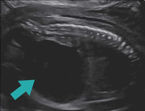 Fetus with LUTO undergoing fetal surgery at the Grant Scott Bonham Fetal Center in Salt Lake City