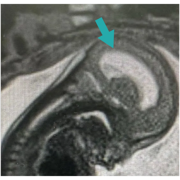 Child with hydrocephalus seen by a multidisciplinary care team at Grant Scott Bonham Fetal Center