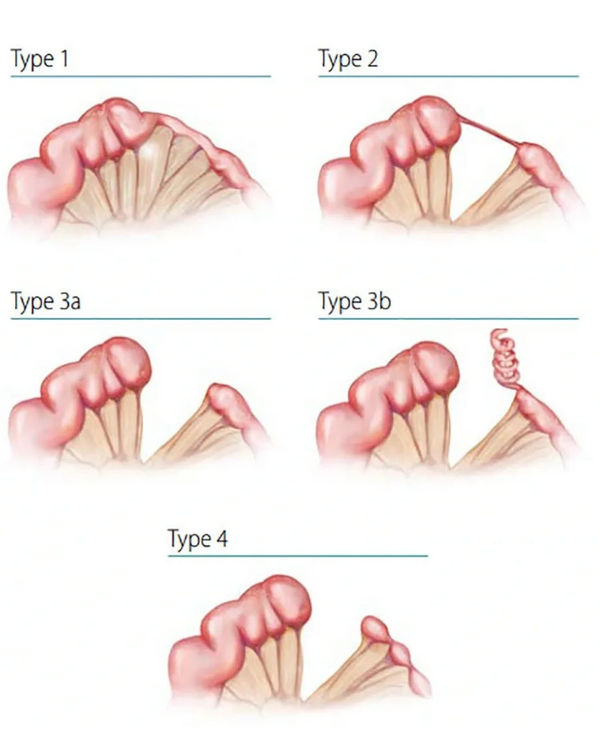 Types of intestinal atresia treated at the Grant Scott Bonham Fetal Center in Salt Lake City, Utah