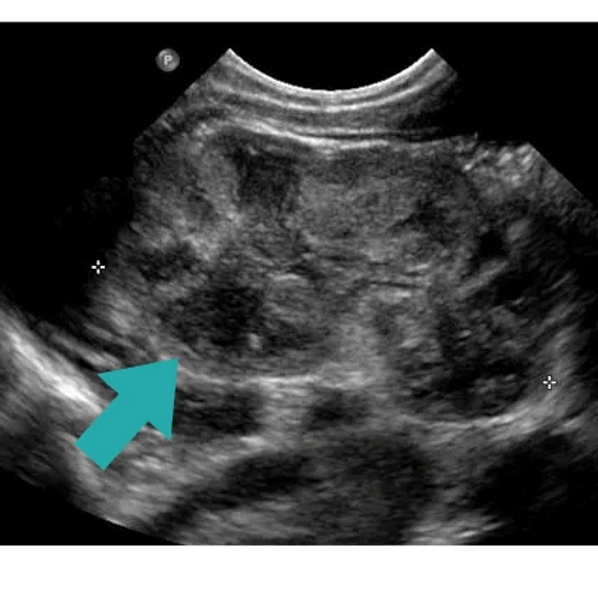 Ultrasound of fetus with renal dysplasia treated at the Grant Scott Bonham Fetal Center in Utah