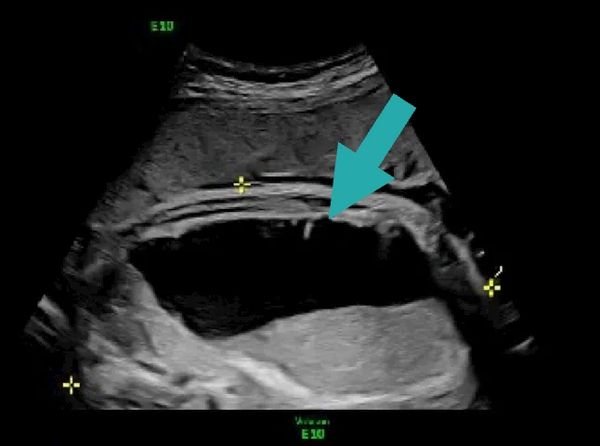 Intraabdominal cyst treated at  the Grant Scott Bonham Fetal Center at Primary Childrens Hospital