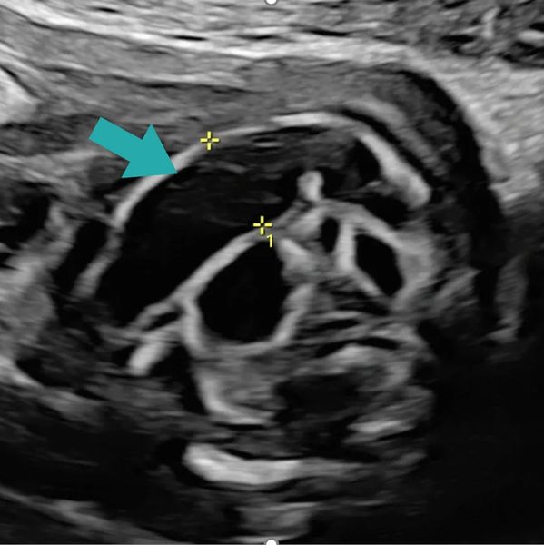 Ultrasound of fetus with intestinal obstruction treated at the Grant Scott Bonhan Fetal Center