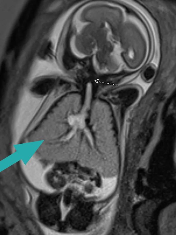 MRI of baby with CHAOS treated at the Grant Scott Bonham Fetal Center at Primary Childrens Hospital