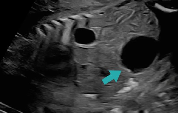 Ultrasound image showing two anechoic cystic structures in soft tissue.