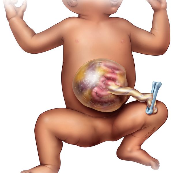 Depiction of a child with a giant omphalocele undergoing care in Salt Lake City, Utah