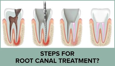 root canal dental