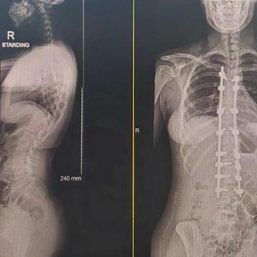 X-ray images showing spinal surgery and correction with metal rods.