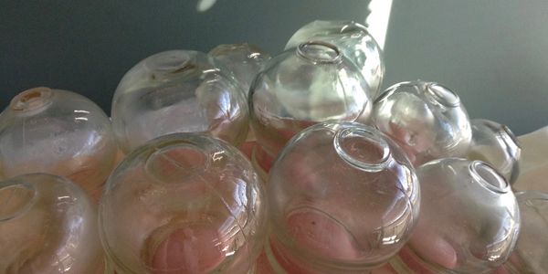 Close-up of a cupping treatment with glass cups on a patient's back.