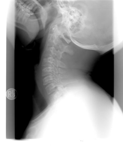 X-ray showing part of jaw and neck