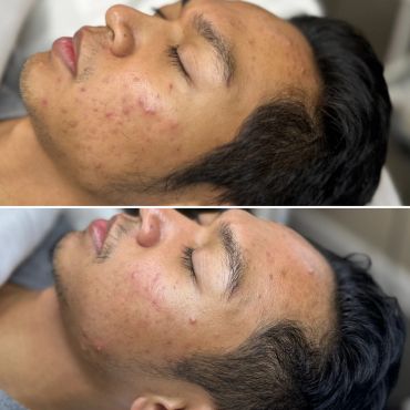 Before and after acne treatment results on a young man's face.