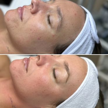 Close-up skin improvement on a woman's face before and after skincare treatment.