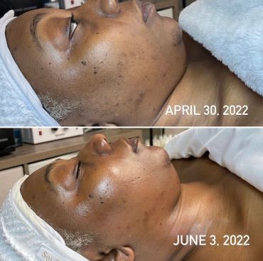 Skin improvement comparison from April to June 2022.