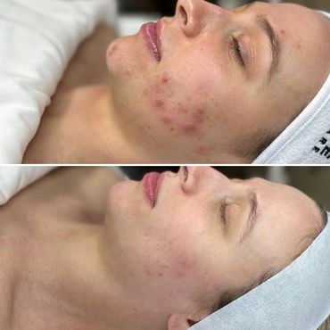Before and after images showing significant acne improvement on a woman's face.
