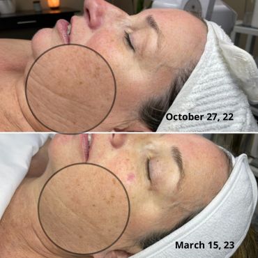 Before and after skin treatment showing improved skin texture.