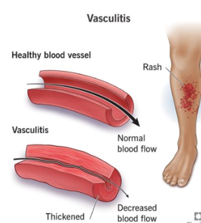 Comparison of healthy and vasculitis-affected blood vessels with leg rash.