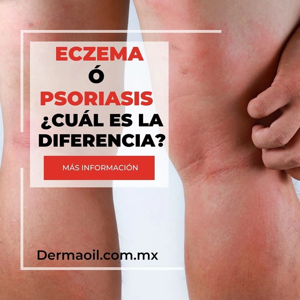 Eczema o Psoriasis ¿Cuál es la diferencia?
