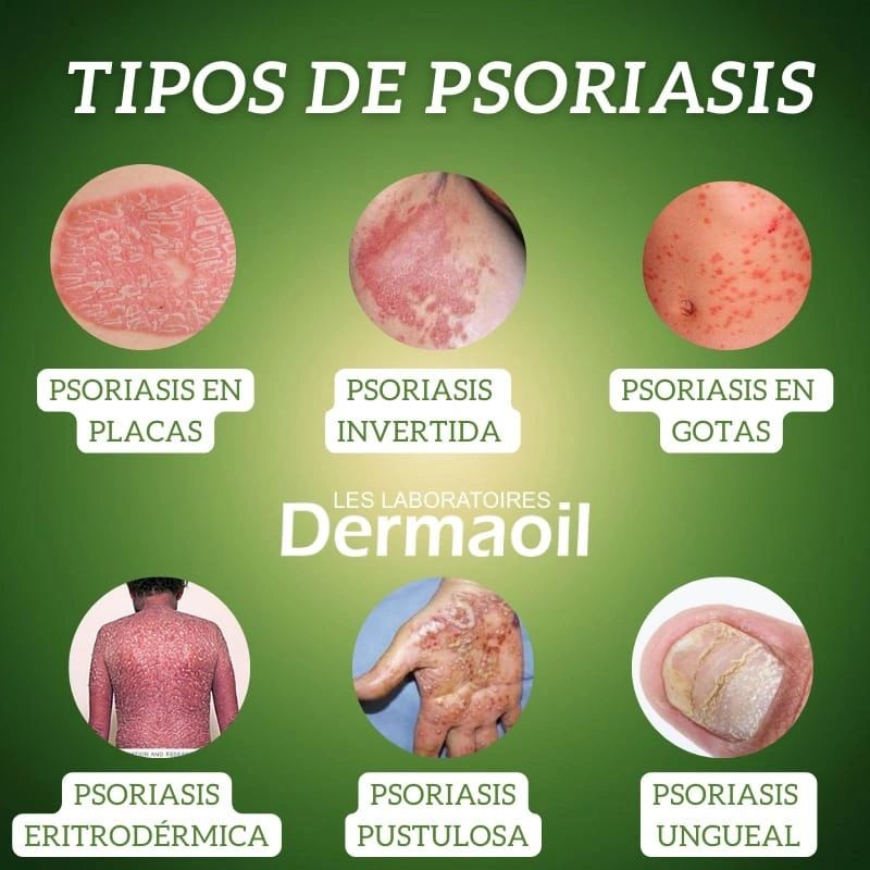 TIPOS DE PSORIASIS